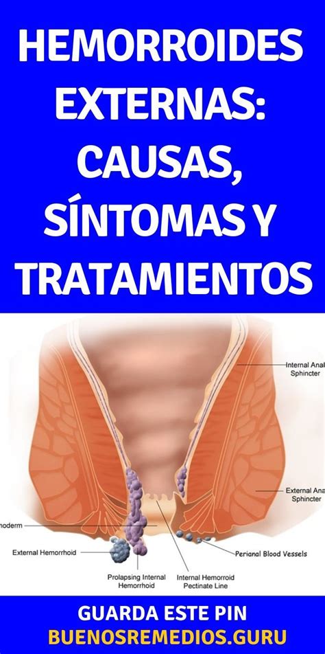 hemorroides externas fotos y videos|Tipos De Hemorroides: Imágenes Y Información 